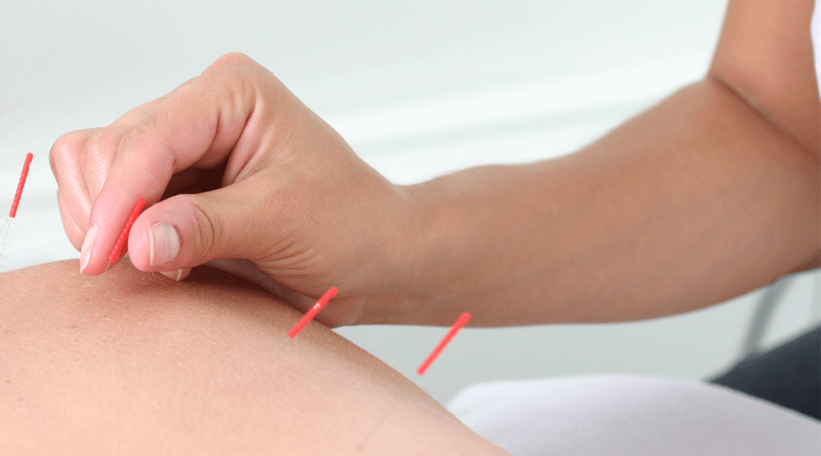 A woman getting acupuncture therapy or dry needling therapy lying down